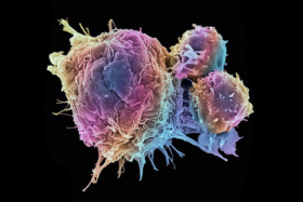 chemotherapy